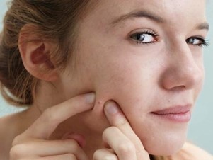 Chăm sóc làn da dầu mụn ở tuổi dậy thì rất quan trọng