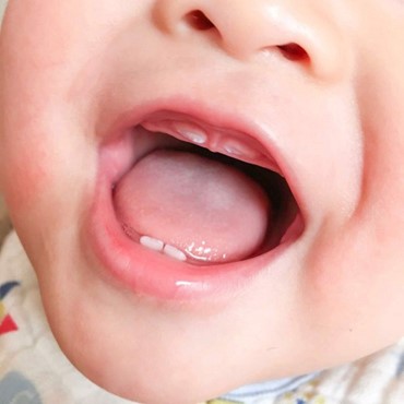 Hiện tượng trẻ nhỏ sốt mọc răng