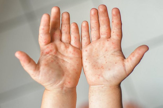 Biểu hiện qua từng cấp độ của bệnh tay chân miệng